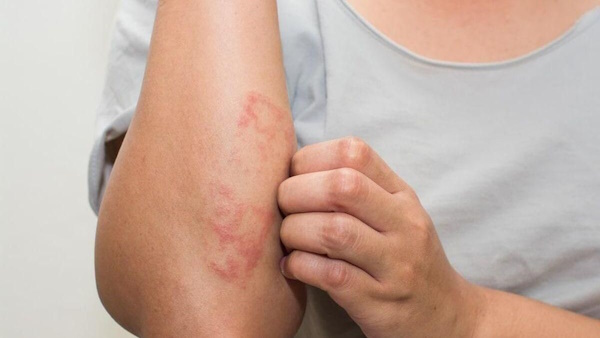 Un brote de sarna afecta a doce mayores en una residencia de Alhaurín de la Torre (Málaga)